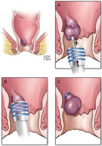 A Comprehensive Guide to Grade 1 Hemorrhoids