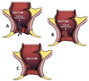 A Comprehensive Guide to Grade 1 Hemorrhoids