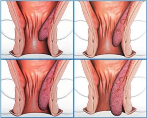 External Hemorrhoid Recurrence Grade 2: