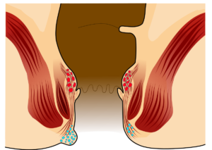 Finally External Hemorrhoid Recurrence Grade 2: