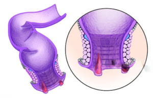 Comprehensive Guide to Internal Hemorrhoid Treatment 2024