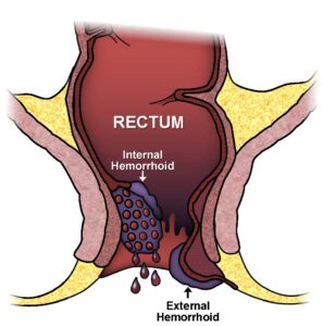 Rectal Thrombosis: Understanding Blood Clots in the Rectal Area