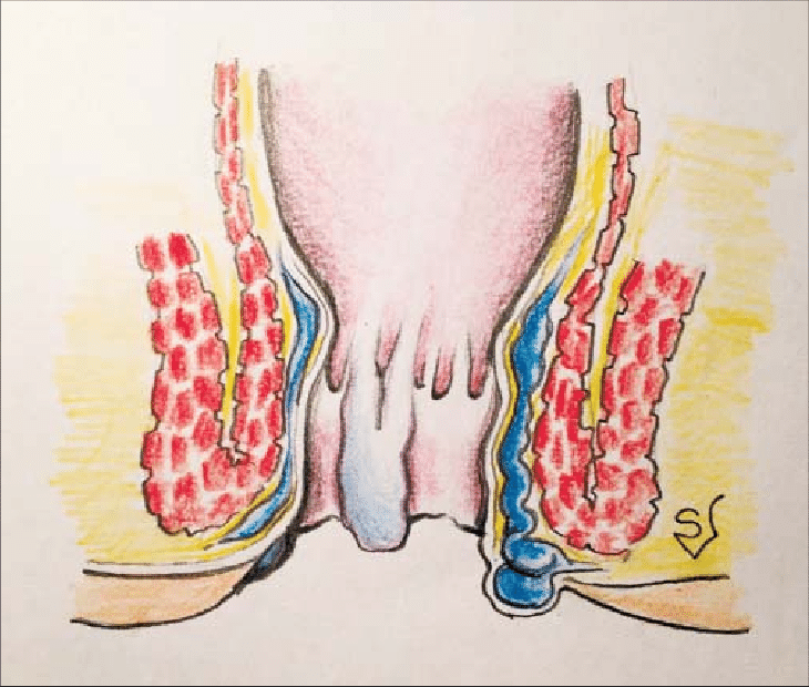 External Hemorrhoid Grade 4 Comprehensive Overview.