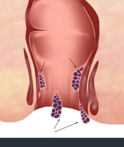 External Hemorrhoid Grade 3 Comprehensive Overview of Causes Symptoms and Treatments