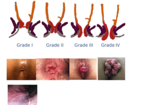 External Hemorrhoid Grade 4| Overview of Causes, Symptoms, and Treatments