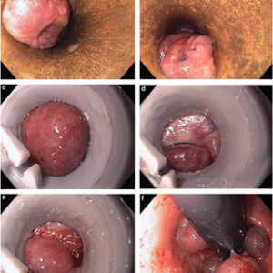 External Hemorrhoid Grade 4| Overview of Causes, Symptoms, and Treatments