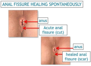 Ultimate Guide to Severe Anal Fissure Healing-2024