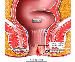 Ultimate Guide to Severe Anal Fissure Healing-2024